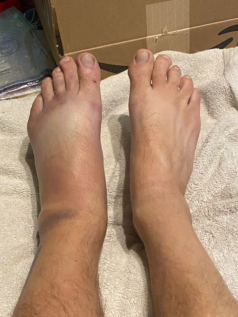 Feet with bruising and swelling.